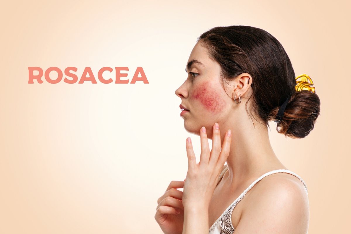 What is Rosacea - Causes, Symptoms, Treatment